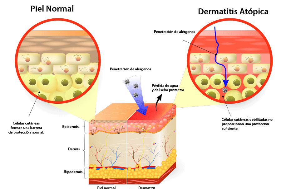 schéma cutané de la dermatite atopique