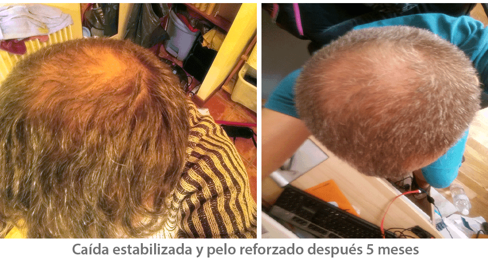 Foto antes y después del tratamiento anticaída
