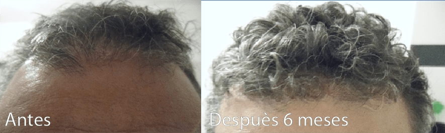 foto antes y después rebrote pelo hombre