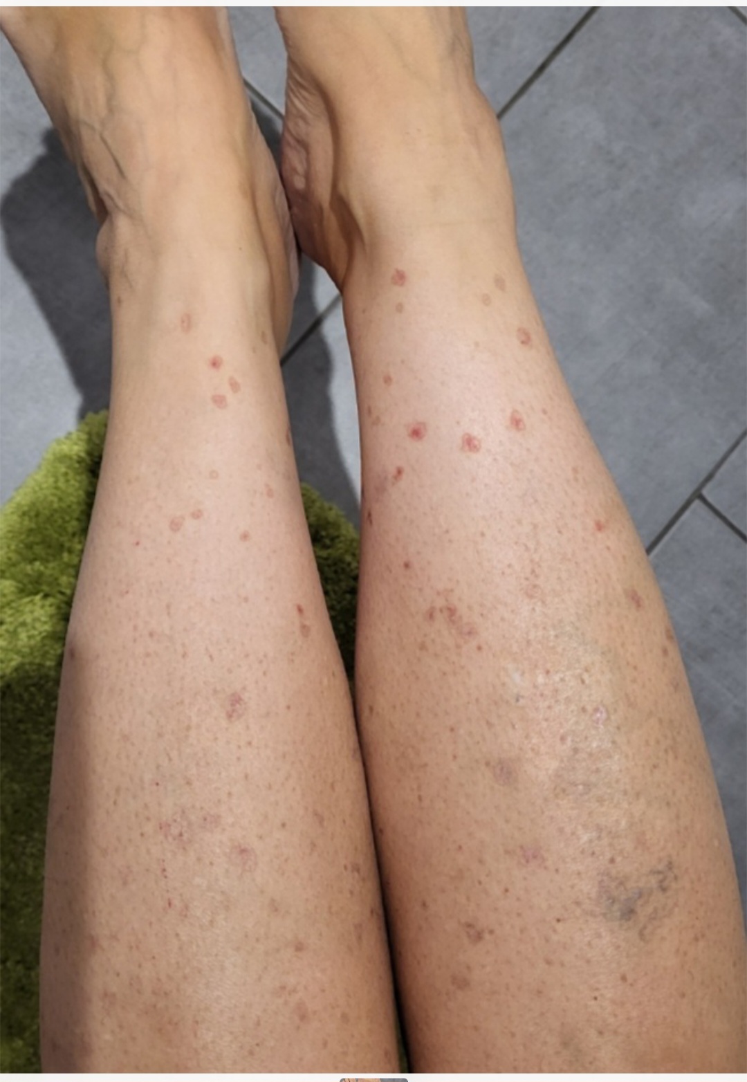 Keratosis before treatment