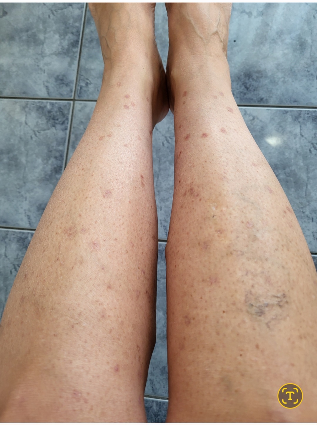 Keratosis after 3 days of Géomer product application