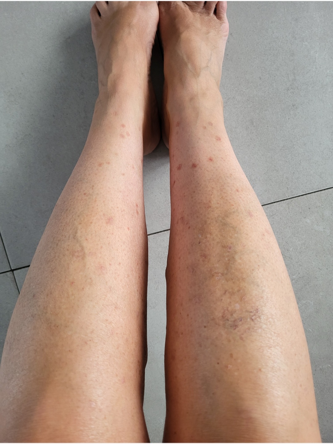 Queratosis tras 14 días de aplicaciones