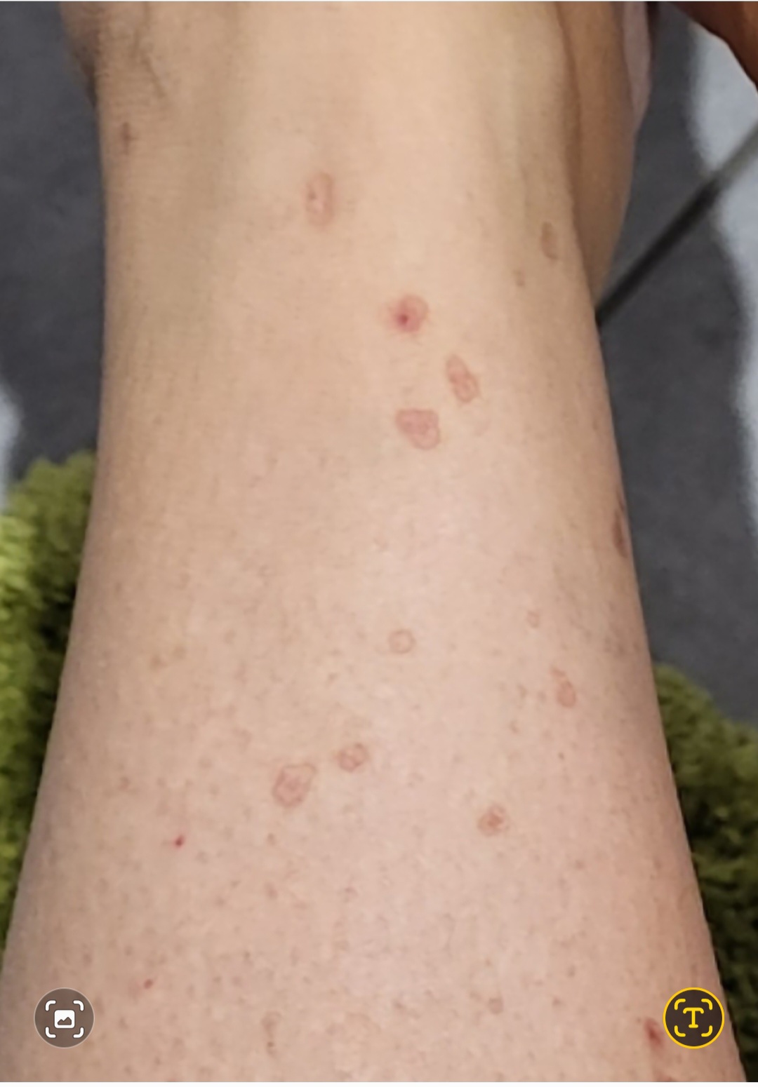 Queratosis en las piernas