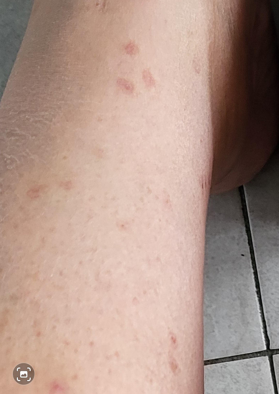 Queratosis tras 3 días de aplicaciones