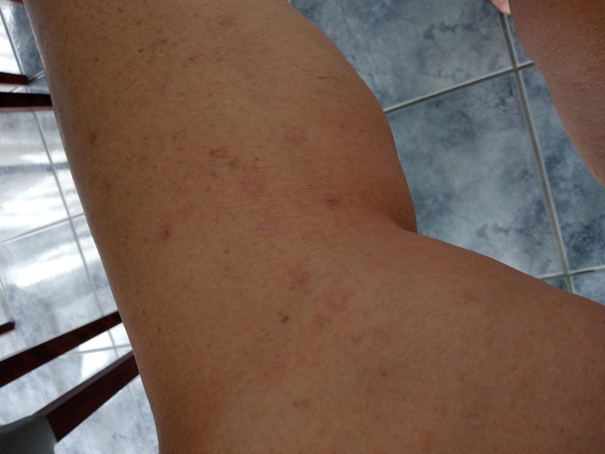 Los brazos de Lise