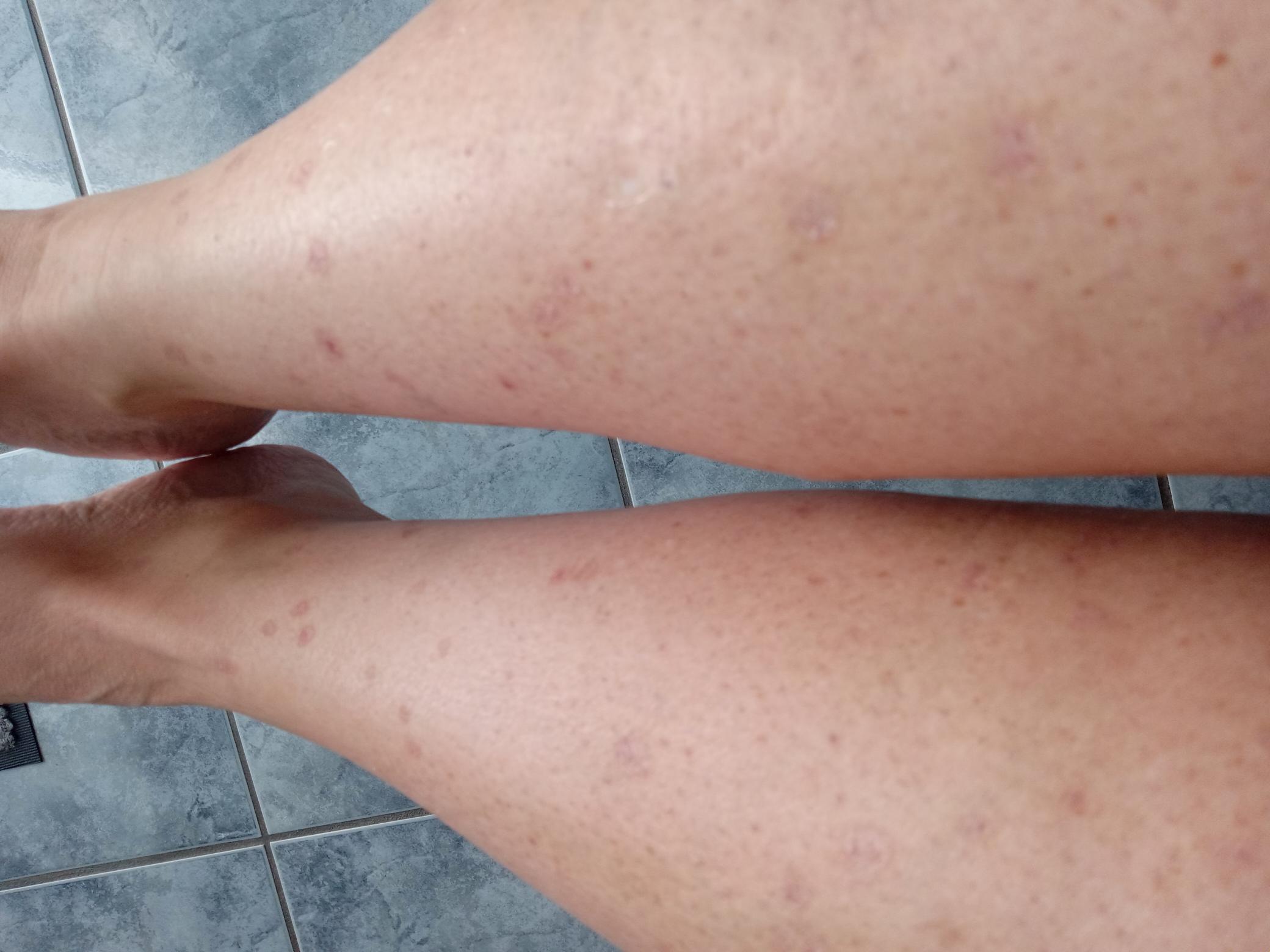 Legs before treatment