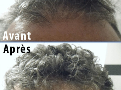 Testimonial Stéphane Laugier effective treatment against hair loss